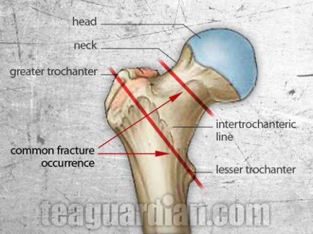 Structure of the femur and common occurrence of hip fracture