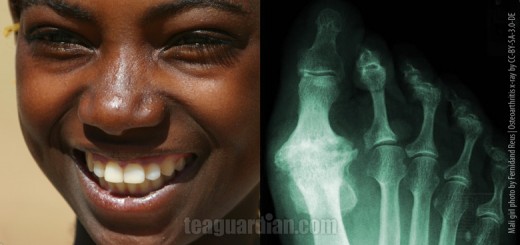 Fluorides: Good or Bad