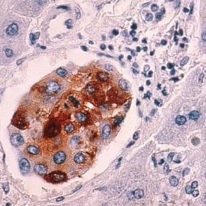 Breast cancer cells spreading to the liver
