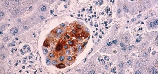 Breast cancer cells spreading to the liver