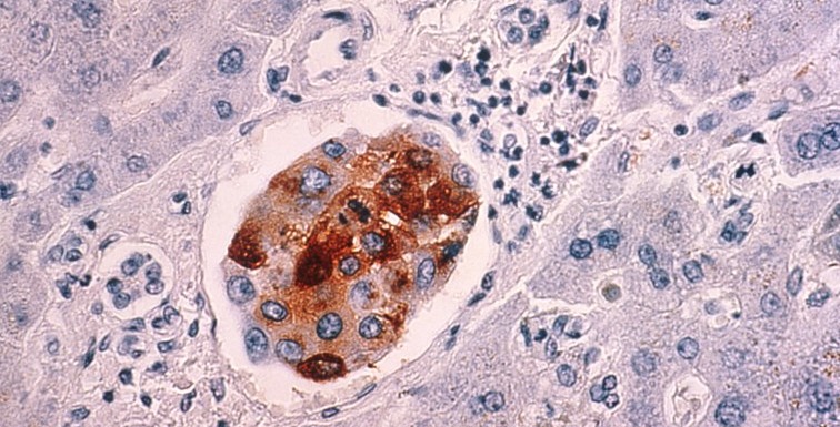 Breast cancer cells spreading to the liver
