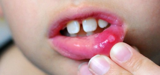 Mouth ulcer