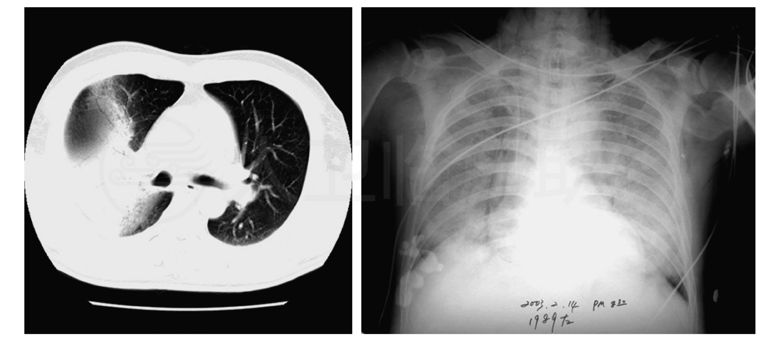 X-ray of a 2003 SARS patient in China